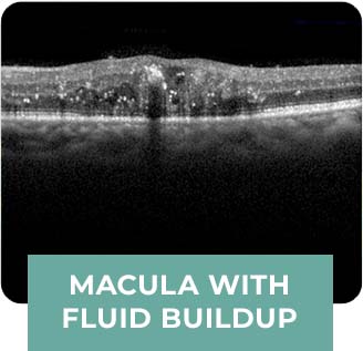 Macula with Fluid Buildup